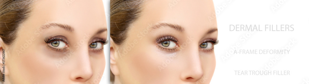 Fototapeta premium Tear Trough Filler,A-frame deformity. Fat grafting or dermal filler treatments .Hyaluronic acid injections for specific areas.
