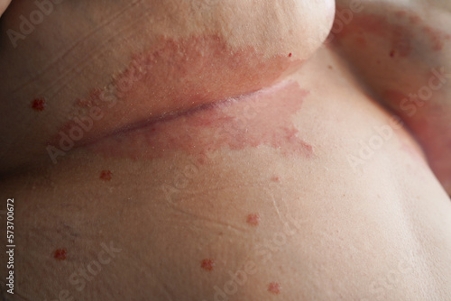 Psoriasis skin. Psoriasis is an autoimmune disease that affects the skin cause skin inflammation red and scaly. photo