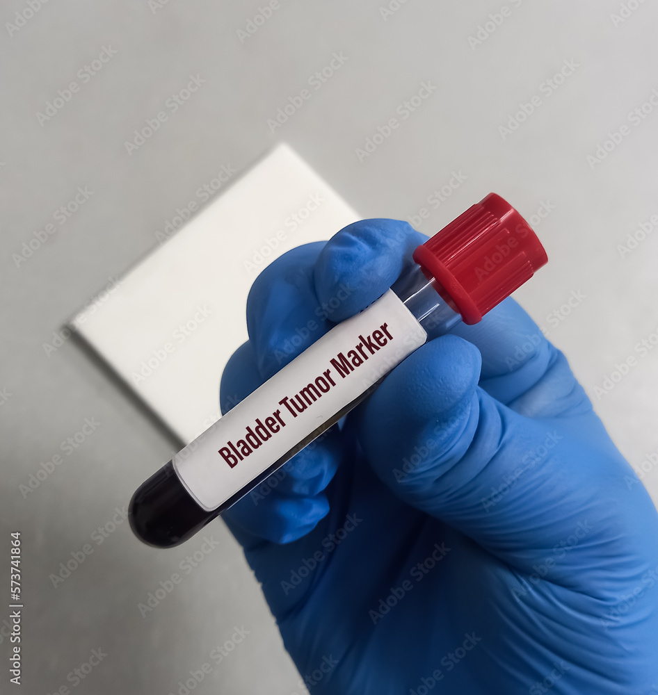 Blood sample for Bladder cancer marker test. bladder tumor antigen (BTA