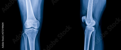 Blue tone radiograph on dark background in hospital.Doctor used xray for diagnosis of the illness of patient.X-ray of normal knee in AP and lateral in orthopedic unit.Xray in hospital.Medical concept. © Issara