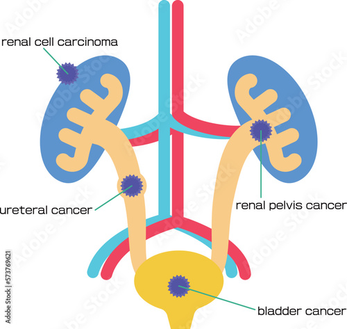 膀胱、腎臓周辺にできる癌の種類／Types of cancer around the bladder and kidneys