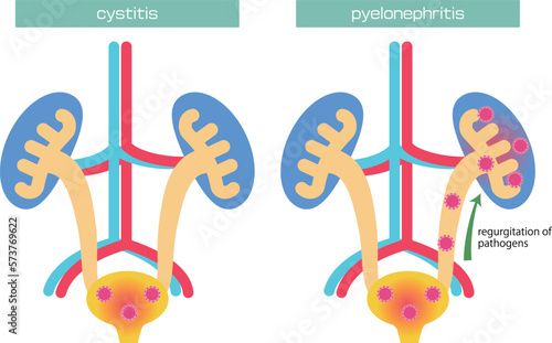 膀胱炎と腎盂腎炎のイラスト／Illustration of cystitis and pyelonephritis
