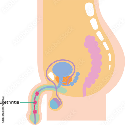 尿道炎を表したイラスト／Illustrated internal organs with urethritis