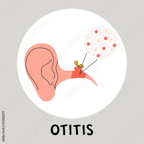Otitis media flat vector medically illustration. Earache becouse of infection in the middle ear. Inflammatory diseases