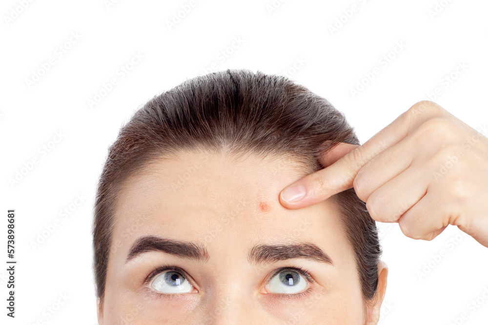 Woman shows a finger to a red pimple on her face health problems acne. Problematic skin. Close-up photo on a white background Woman shows a finger to a red pimple on her face health problems acne. Problematic skin. Close-up photo on a white background