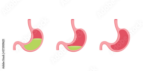 Scientific Designing of Difference Between Hypochlorhydria and Achlorhydria. Vector Illustration.