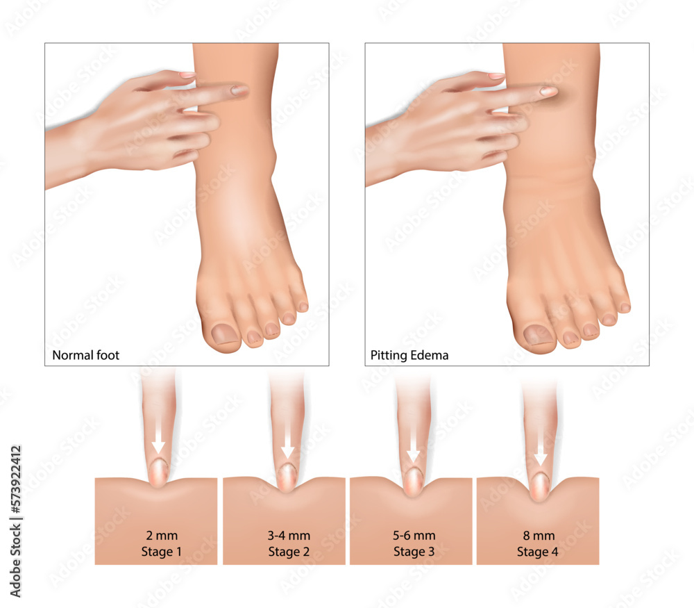 Vetor Do Stock Pitting Edema And Normal Foot Oedema Fluid Retention vetor-do-stock-pitting-edema-and-normal-foot-oedema-fluid-retention