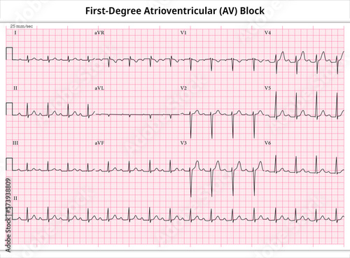 First Degree Atrioventricular Block - ECG Paper 12 Lead - Electrocardiogram - Vector Medical Illustration