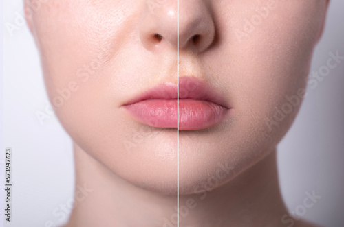 female thin lips before and after hyaluronic acid filler injection as result collage, lip augmentation, lip contour plastic surgery, puffy, plump lips photo