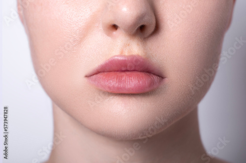 real woman lips after lip augmentation with hyaluronic acid filler injection finished result, contour lip plastic surgery, puffy, plump lips