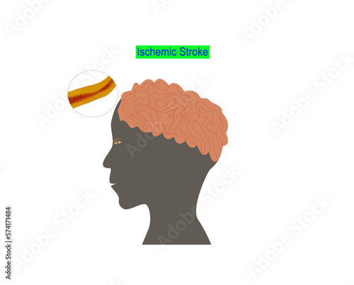 Ischemic Stroke, arteriosclerosis disease accumulation of cholesterol and fats in the walls