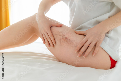 Woman sitting on bed and shows her slim legs with varicosity. Close up of female hip. Concept of laser epilation and varicose