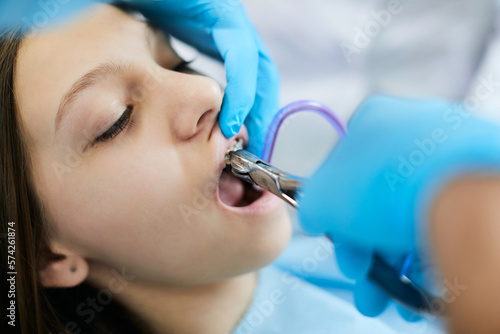 Close up of orthodontist removing girl's dental braces at dental clinic.
