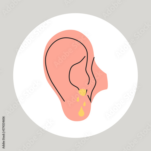 Fluid draining from the ear. Otitis, tinnitus symptom. Bacteria in the middle ear. Flat vector medical illustration