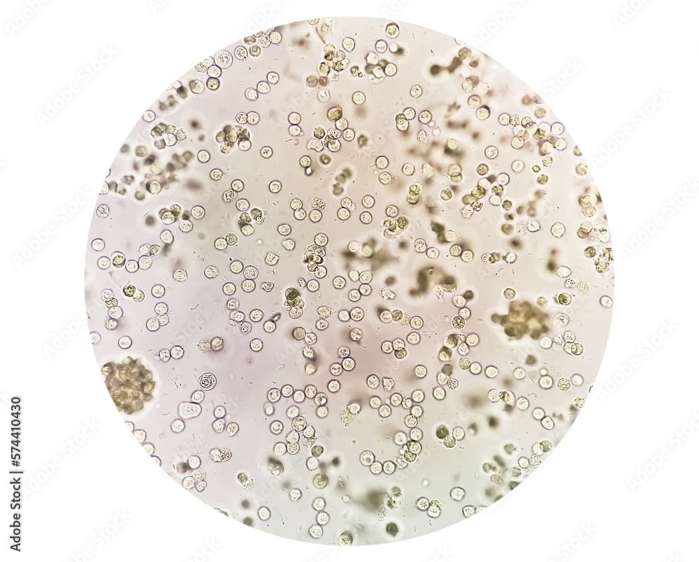 Pyuria or leukocyturia is the condition of urine containing white blood cells or pus. It can be a sign of a bacterial urinary tract infection Pyuria or leukocyturia is the condition of urine containing white blood cells or pus. It can be a sign of a bacterial urinary tract infection