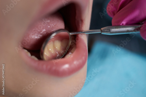 A close-up of a young girl getting a dental exam by dentist and using dental mirror to see baby teeth and gums. photo