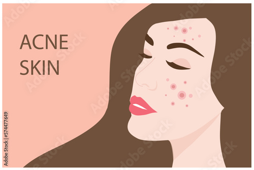 Young woman face with skin acne, pimples, blackheads vector illustration. Acne skin face problem concept