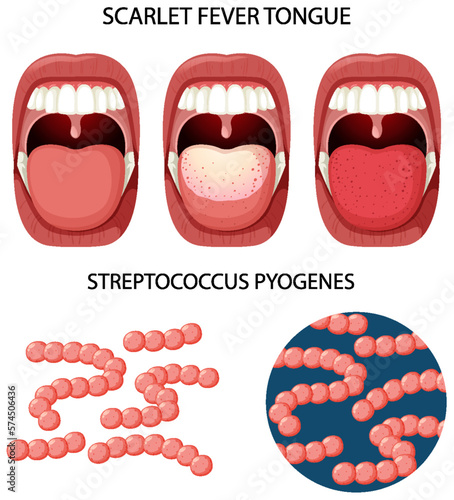 Scarlet fever tongue symptoms