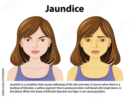 Jaundice disease vector concept photo