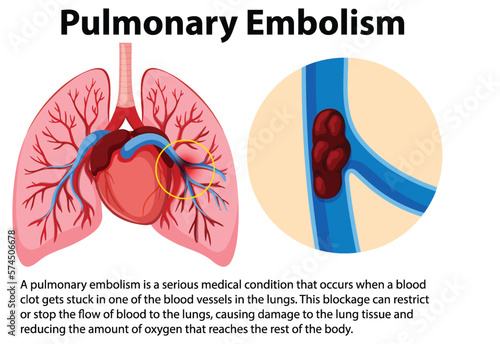 Pulmonary embolism with explanation