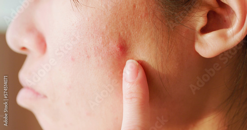 woman acne problem on face