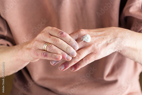 Foto Applying ointment to hands with atopic dermatitis, eczema, allergy