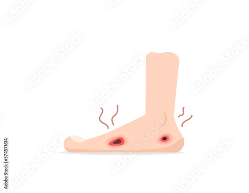 illustration of a foot that has wounds. scars on feet that darken or rot and smell bad. diabetes's foot. health problems. illustration concept design. design elements