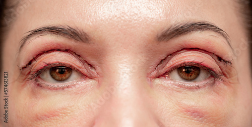 Obraz na plátně Plastic surgery of the face, skin tightening around the eyes