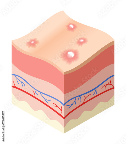 Skincare medical concept. Problems in cross-section of human skin horizontal layers structure. Anatomy illustrative model unhealthly layer of skin