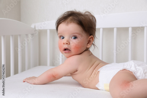 Cute little baby with allergic redness lying in crib at home