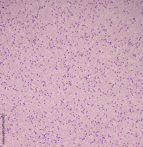 Lymphocytosis with Thrombocytopenia. Smear show white blood cells, red blood cells background. Lymphoproliferative disorder. photo