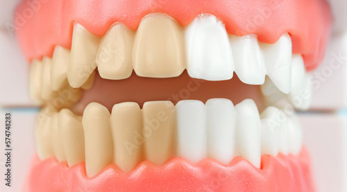 Clean and dirty tooth before and after whitening. Dentistry conceptual photo. Close-up individual tooth tray Orthodontic dental theme.