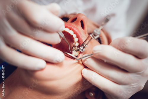 Repairing Teeth