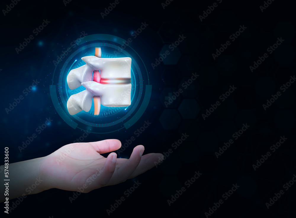 Spinal herniation, herniated disc. low back pain Spine. Severe disc