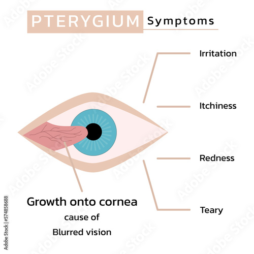 Pterygium signs and symptoms , vector photo