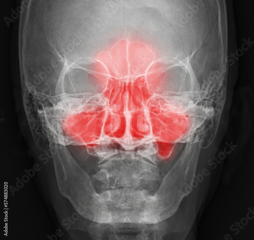 x-ray image of paranasal sinuses for diagnosis sinusitis. photo