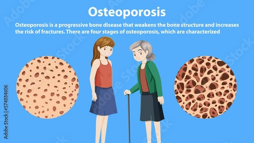 Stages and Progression of Osteoporosis Animation photo