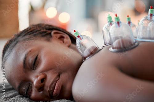 Slika na platnu Black woman, face and smile in cupping therapy on back for pain relief, relaxation or blood flow at resort