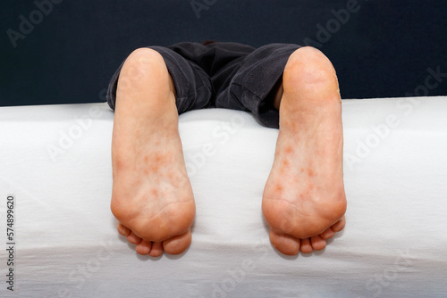 Dyshidrotic eczema skin disease on sole of foot against white background photo