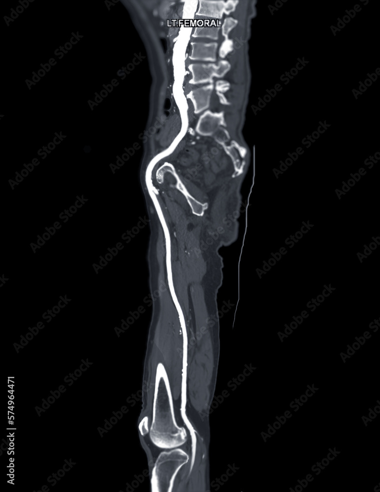CTA femoral artery run off MPR curve showing Left femoral artery for diagnostic Acute or Chronic Peripheral Arterial Disease. CTA femoral artery run off MPR curve showing Left femoral artery for diagnostic Acute or Chronic Peripheral Arterial Disease.