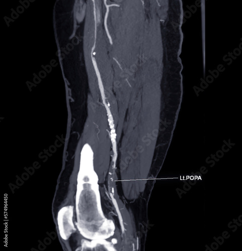 CTA femoral artery run  off MPR curve  showing Left  femoral artery for diagnostic  Acute or Chronic Peripheral Arterial Disease. photo