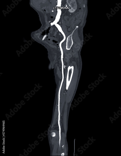 CTA femoral artery run  off MPR curve  showing Left  femoral artery for diagnostic  Acute or Chronic Peripheral Arterial Disease.
