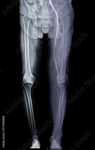 Scanogram image fusion with CTA lower extremities.