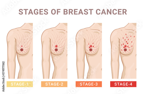 Stages of female breast cancer medical educational scheme vector flat illustration. Mammary disease
