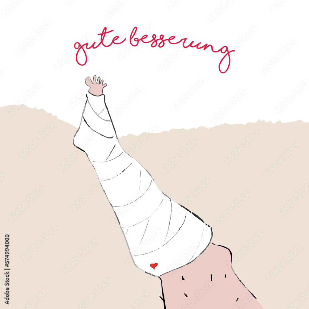 Gebrochenes Bein. Gipsbein. Gute Besserung. Vektorillustration Stock