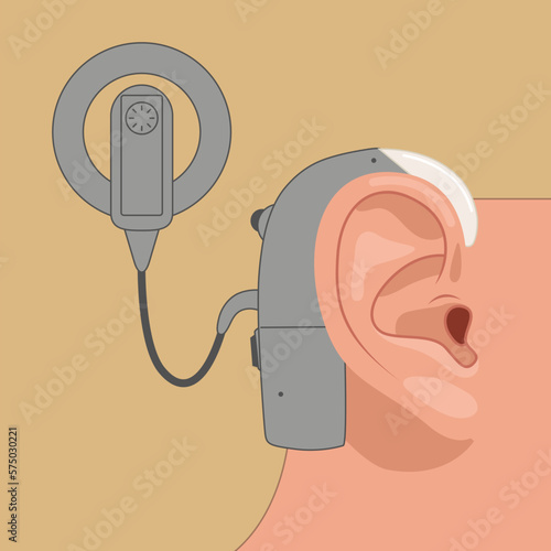 Modern vector illustration in flat style of ear and cochlear implant.