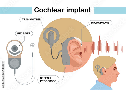 Cochlear implant device electrically stimulates nerve medical aid ear sound wave adults hard middle exam. Modern vector illustration in flat style photo
