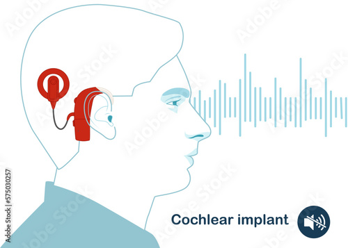 Head with a cochlear implant device in the ear. For the hearing impaired and the deaf, with sound wave. Modern vector illustration in flat style.