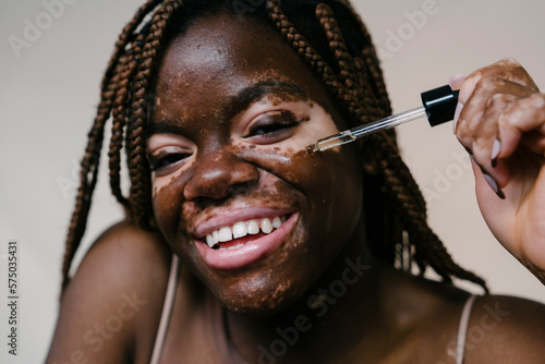 portrait of a pretty african woman with vitiligo applying an essence serum with a dropper while smiling