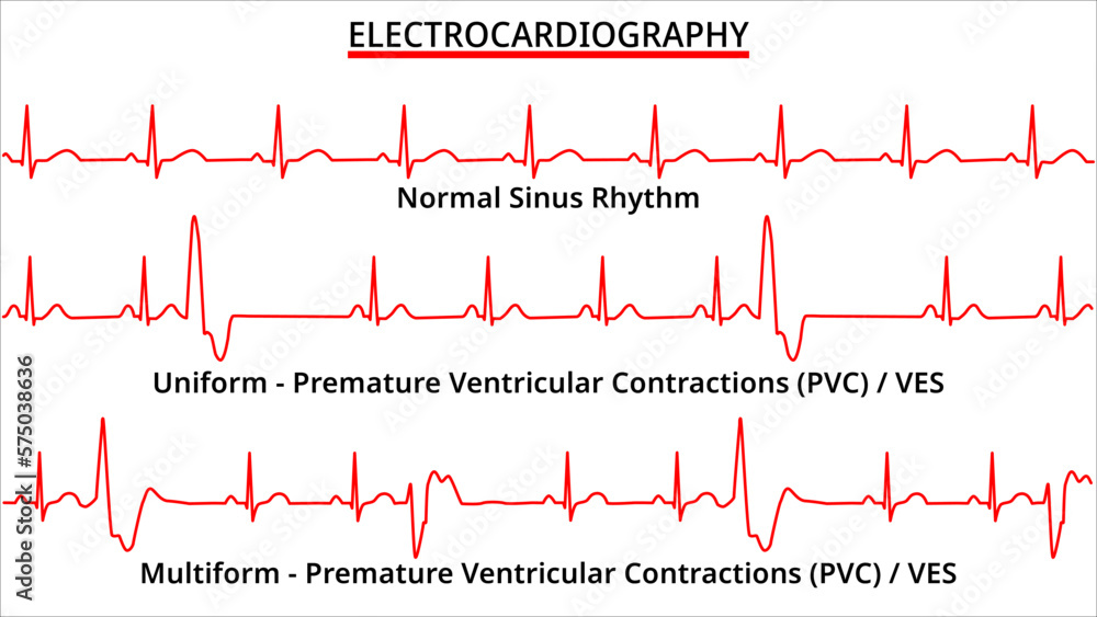 Fototapeta Set of ECG Common Abnormalities - Normal Sinus Rhythm ...